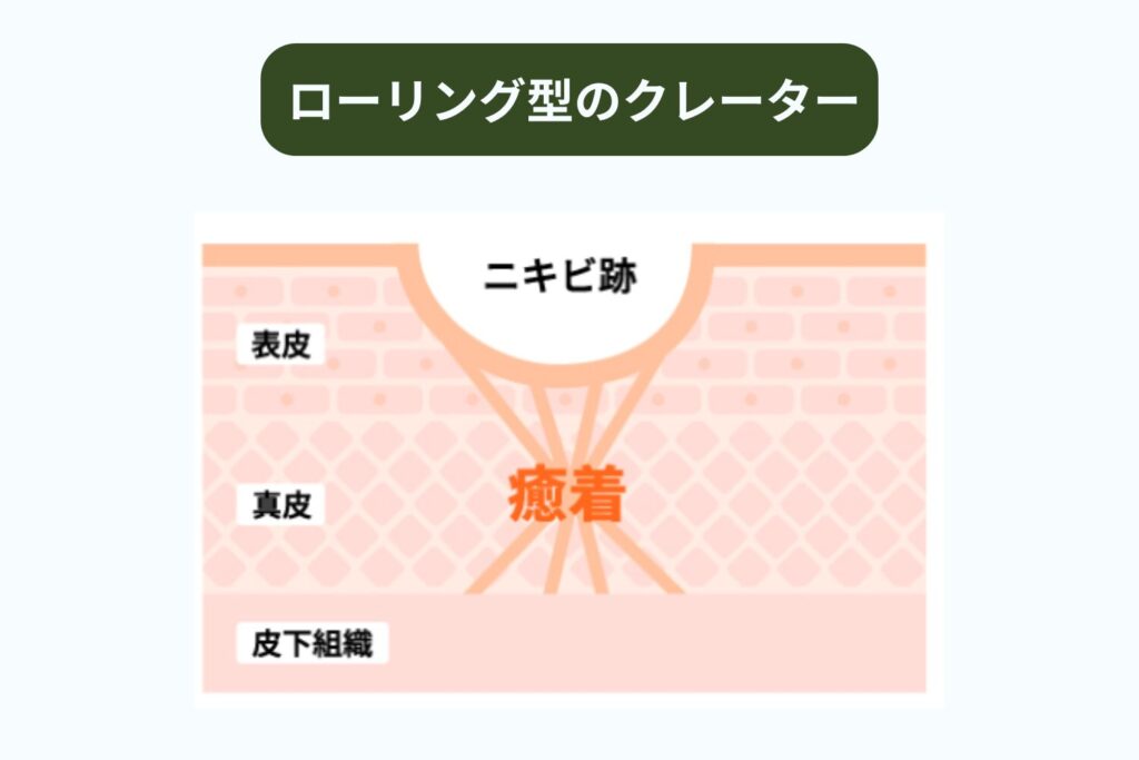 ローリング型ニキビ跡とは何か？