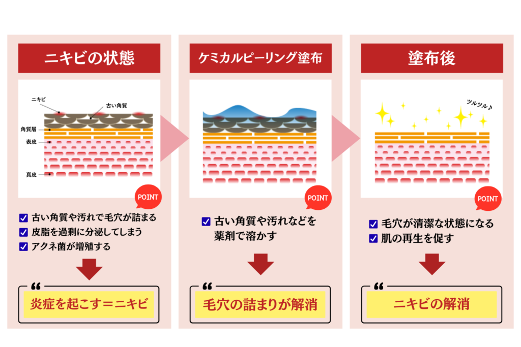 ケミカルピーリングでニキビを予防する