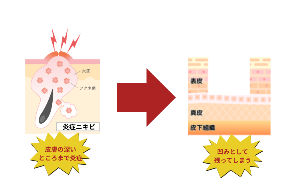 ニキビの炎症が肌の奥まで広がる