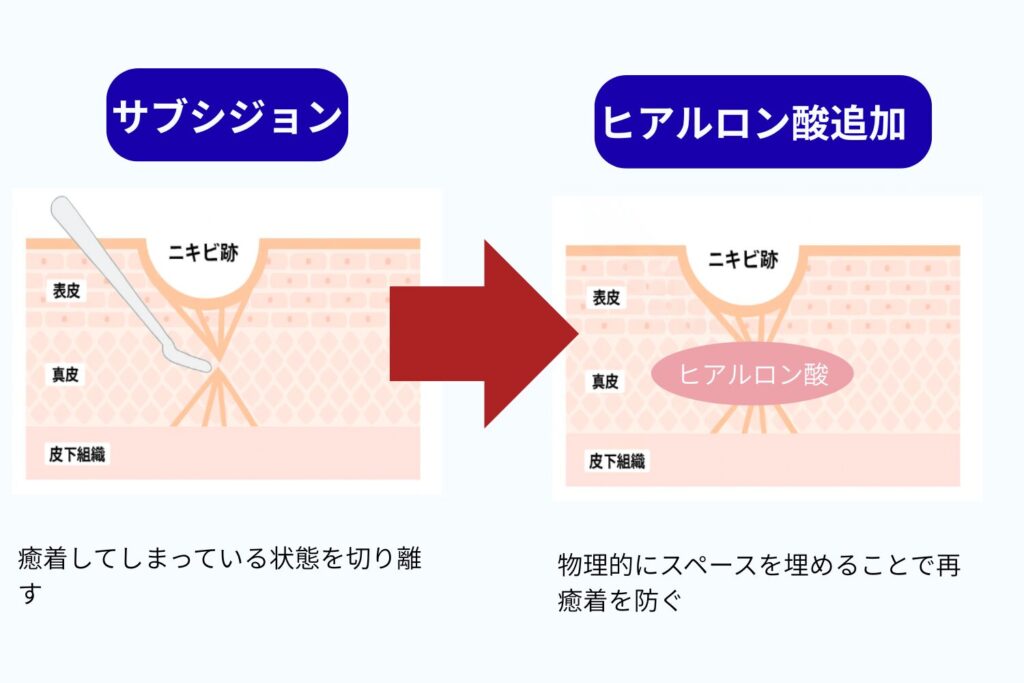 サブシジョンと一緒にヒアルロン酸注入で再癒着を防ぐ