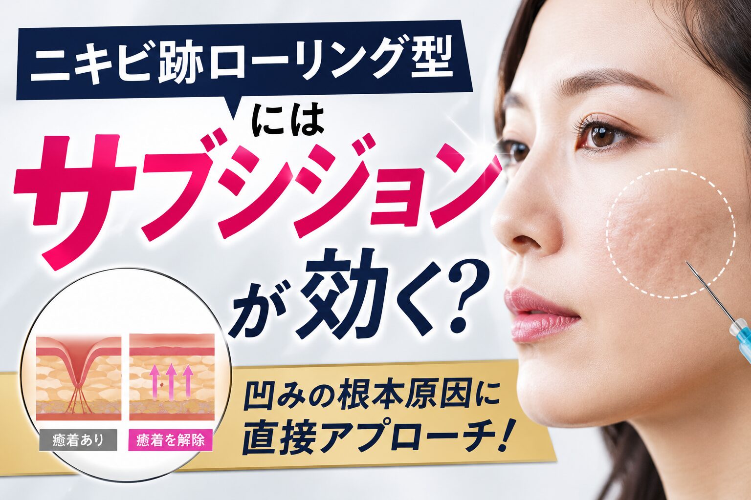 ニキビ跡ローリング型にはサブシジョンが効く?|仕組みと治療の流れを解説