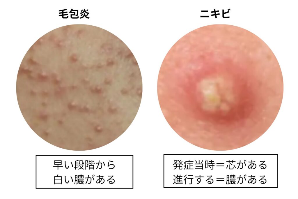 膿や芯の有無を確認する