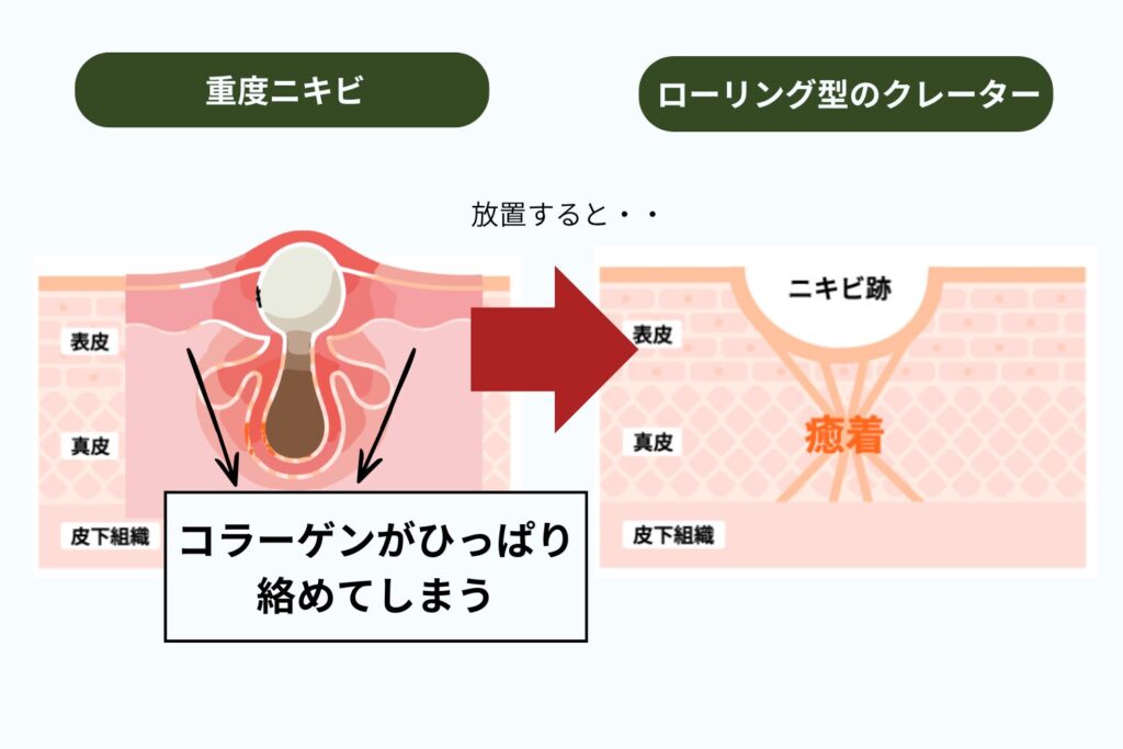 なぜローリング型のクレーターができるの？