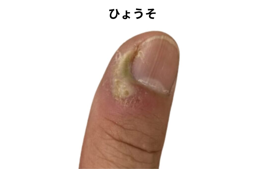 【ひょうそ】痛みがある