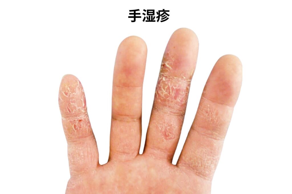 【手湿疹】かゆみが伴う・範囲が広い
