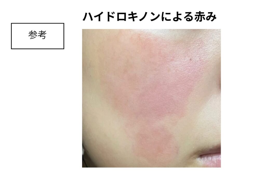 赤みやかゆみが出たら使用を中止する