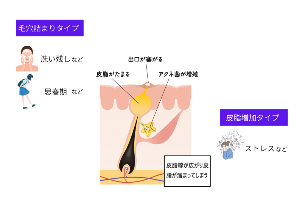 ニキビができる基本の仕組み