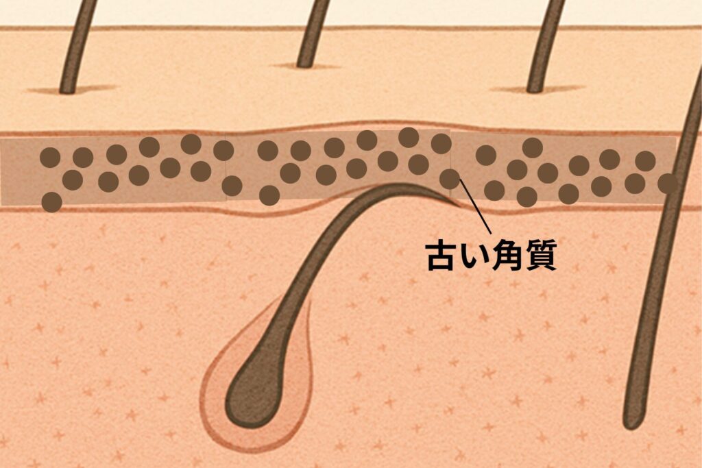 乾燥や古い角質による毛穴詰まり