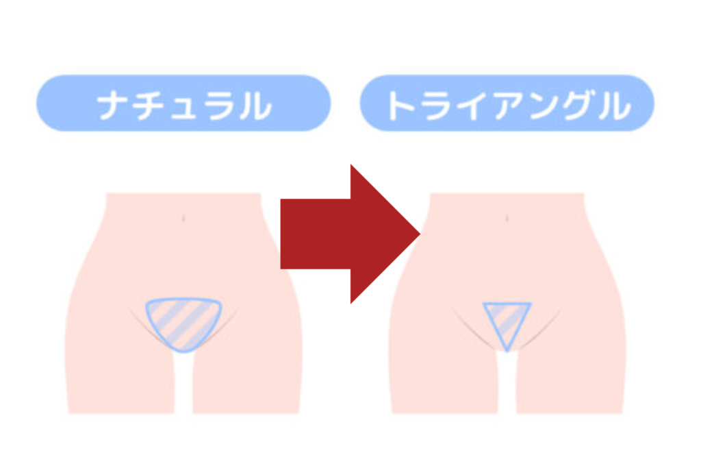 VIOデザインは途中変更できる場合もある