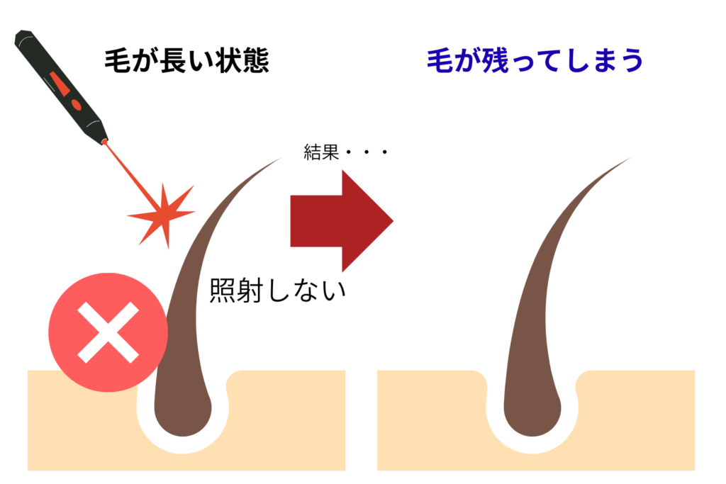 剃り残し部位を避けて照射する場合がある