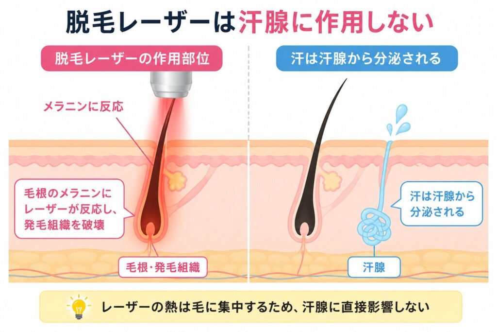 汗腺は脱毛の主な対象ではない