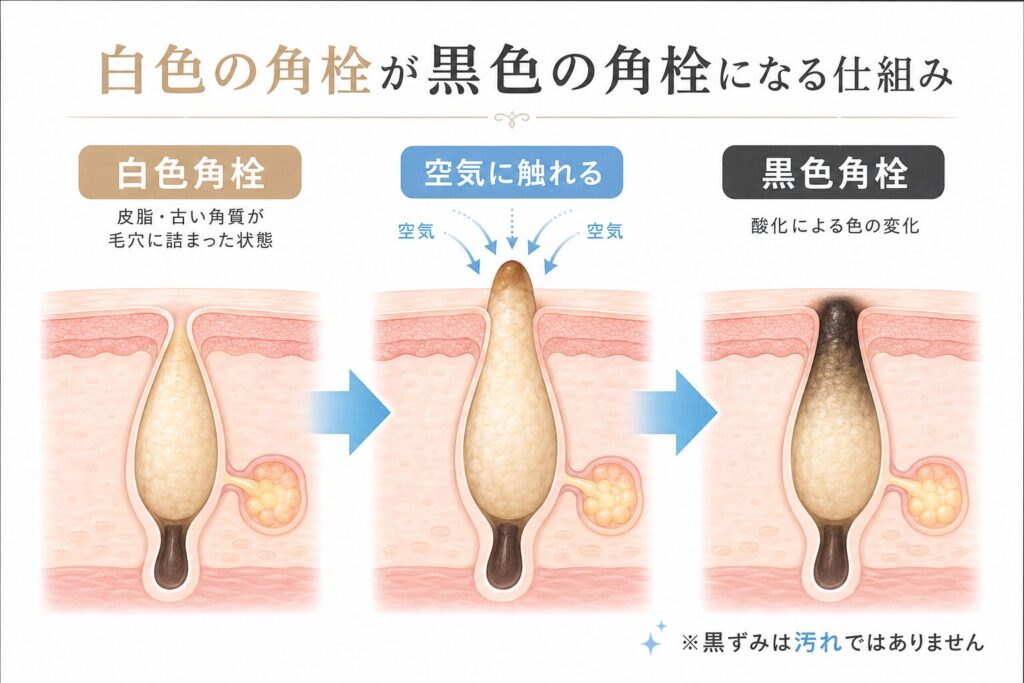 白い角栓と黒い角栓の違い