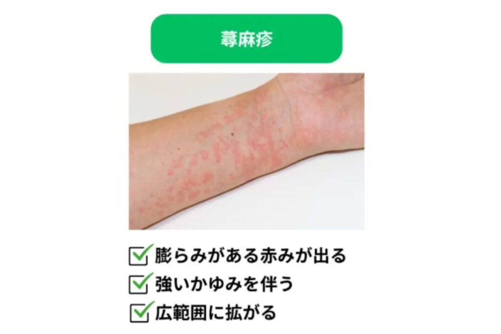 小麦アレルギーは別の肌症状として出ることがある