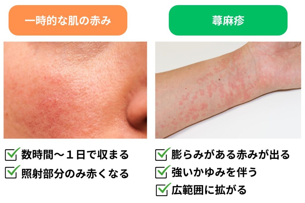 蕁麻疹と一時的な赤みの違いとは？