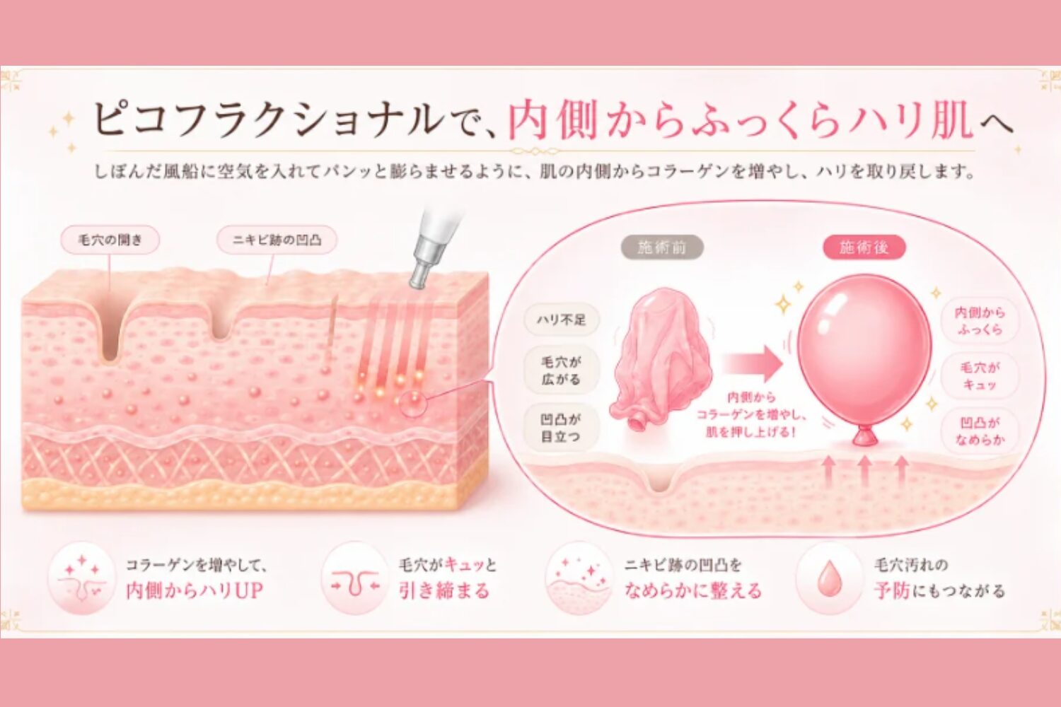 ピコフラクショナル