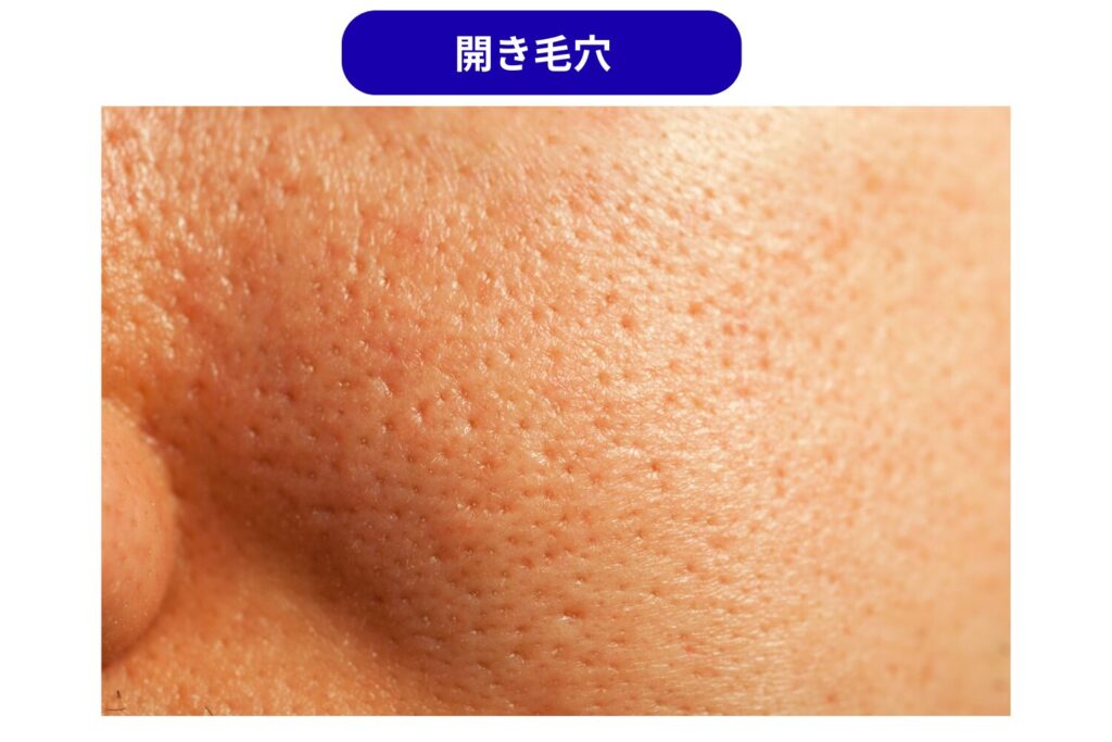 開き毛穴