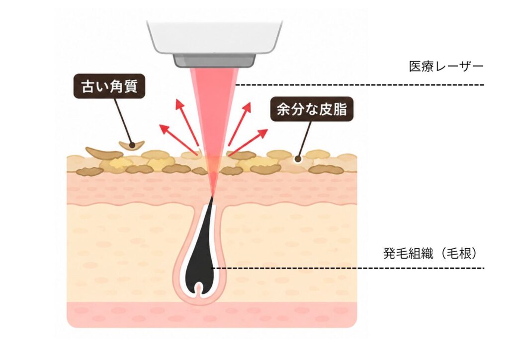 医療脱毛の仕組み