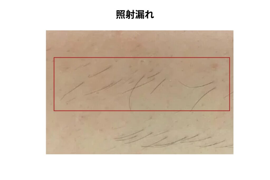 照射漏れによって一部の毛が残っていた