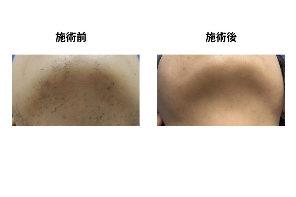 施術前と同じ毛量に戻る可能性は低い