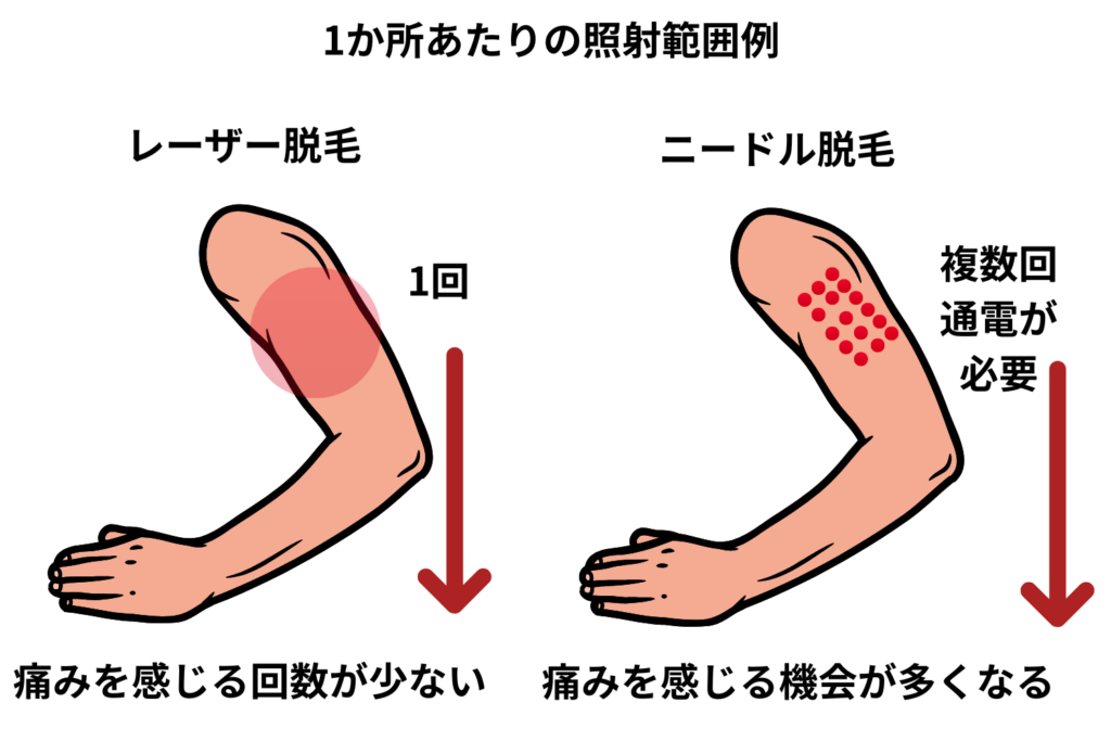 レーザー脱毛との痛みの違い
