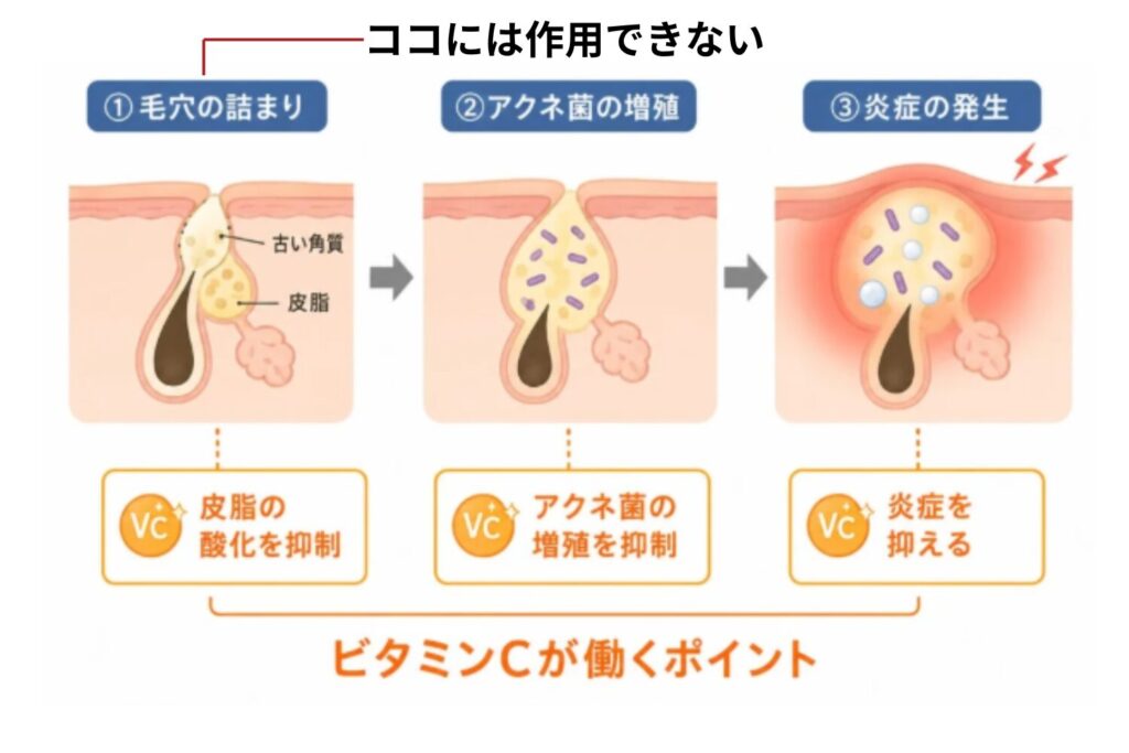 ビタミンCだけでニキビは治せない