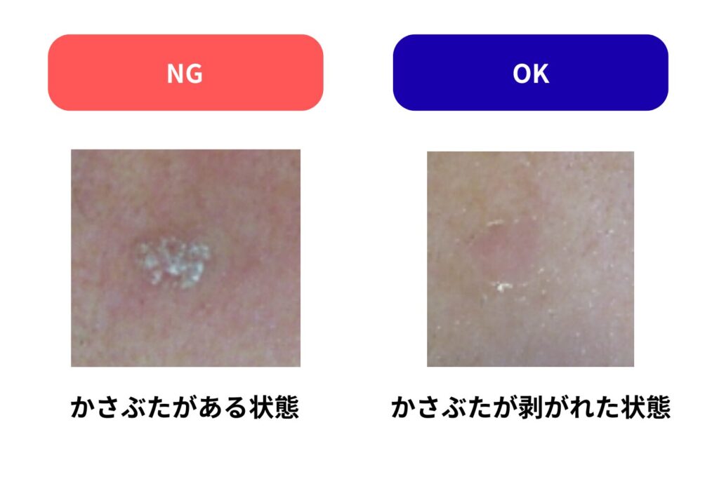 かさぶたが取れた状態を目安にする