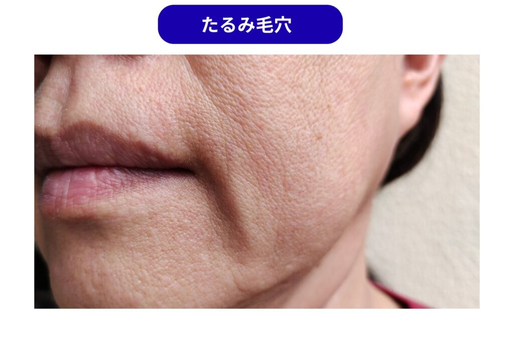 たるみ毛穴