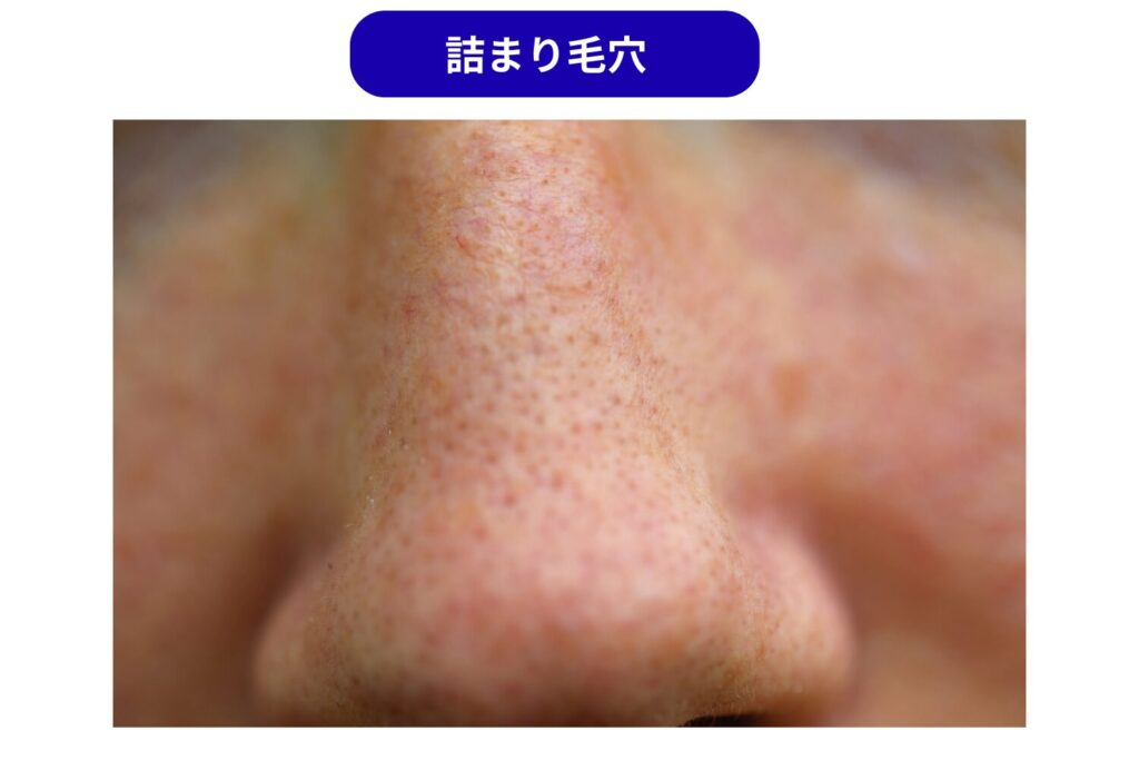 詰まり毛穴