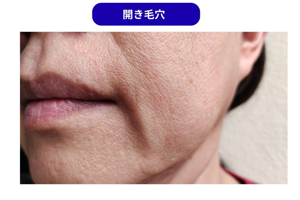 たるみ毛穴