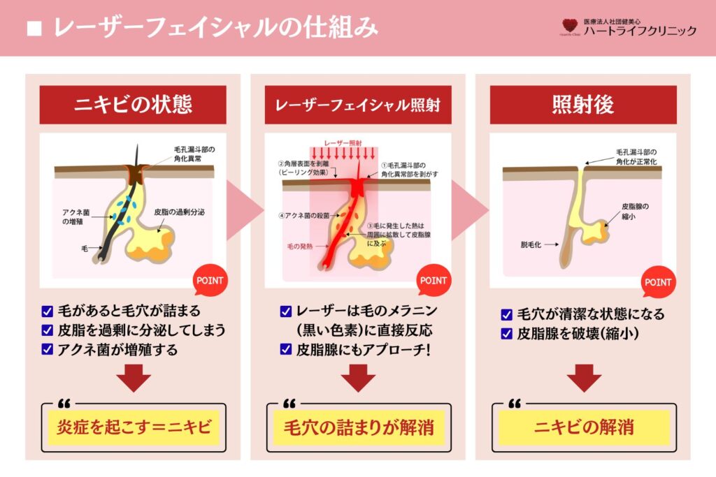 毛穴・シミ・ニキビ・うぶ毛への作用