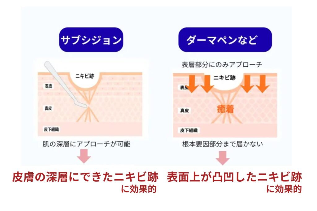 治療の仕組みと作用する深さ
