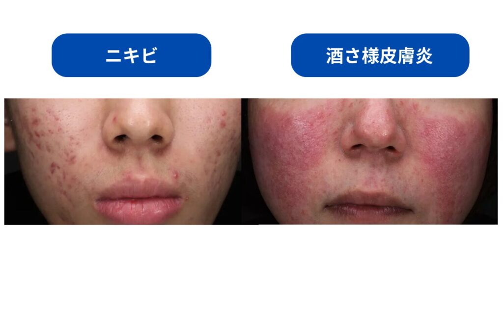 酒さ様皮膚炎