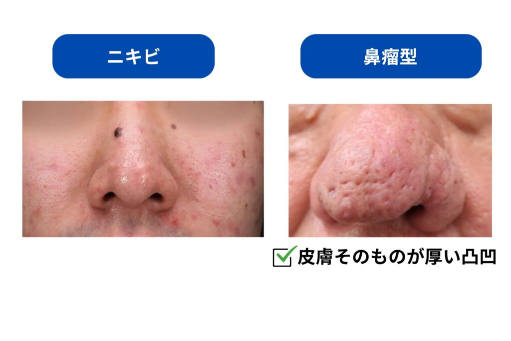 鼻瘤型・眼型