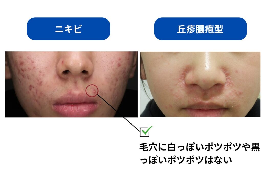 丘疹膿疱型