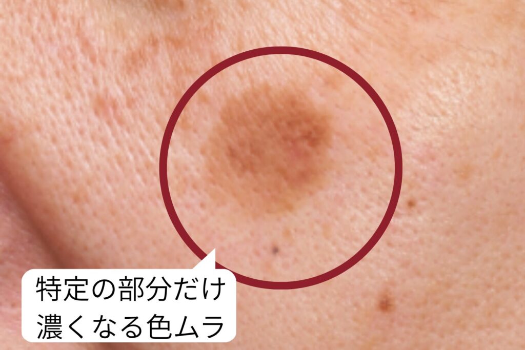 シミは部分的に色が濃くなる