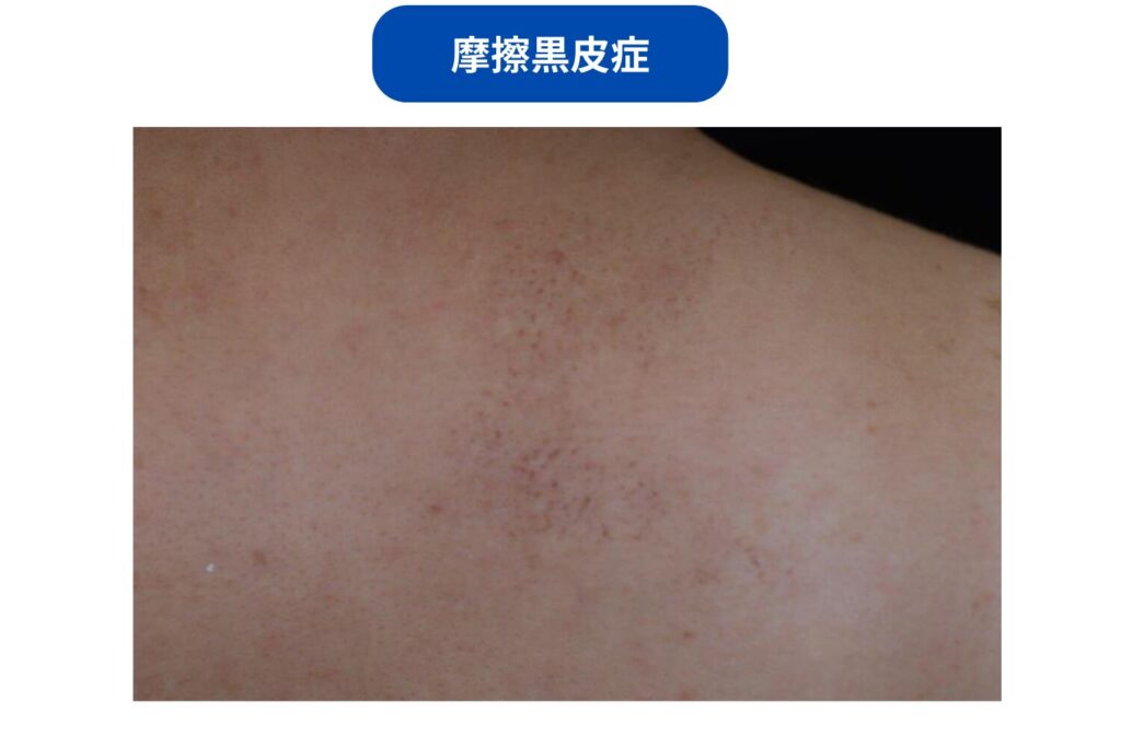 摩擦黒皮症