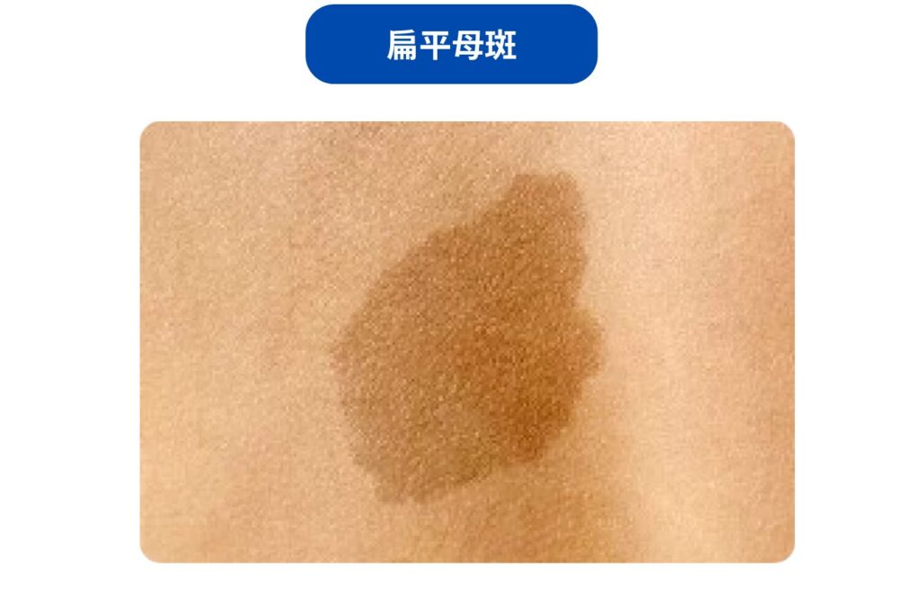 扁平母斑などのあざ