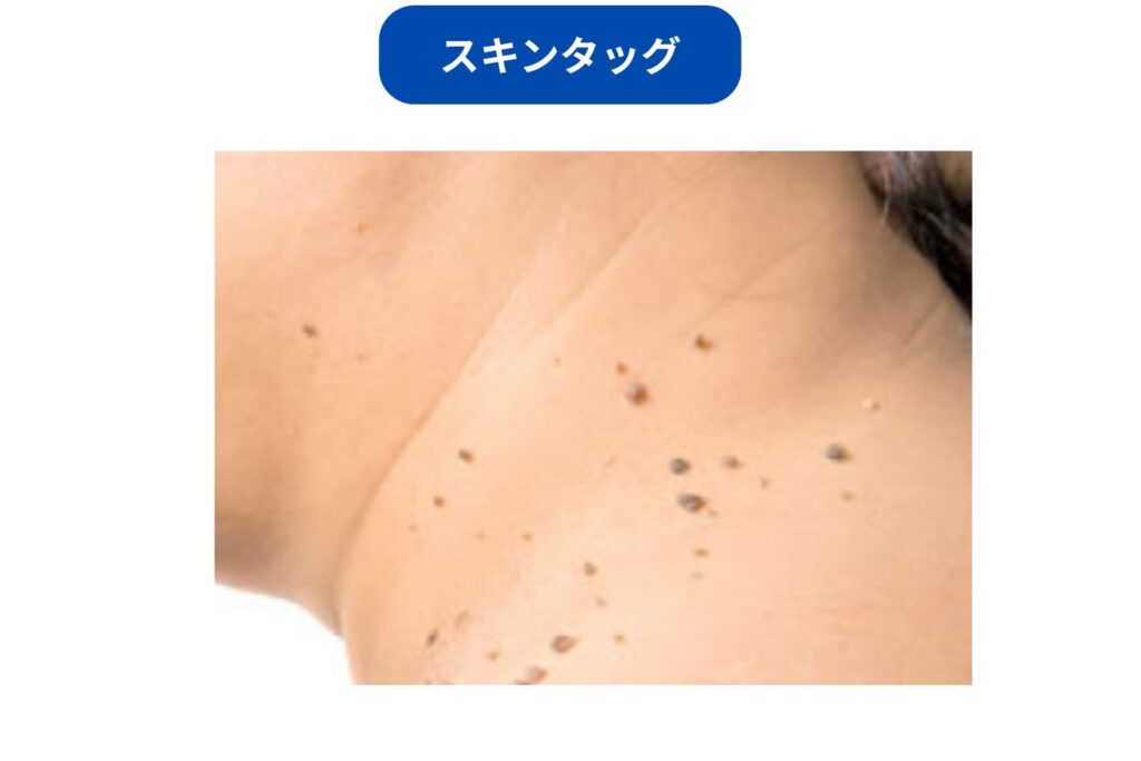 スキンタッグ・軟性線維腫
