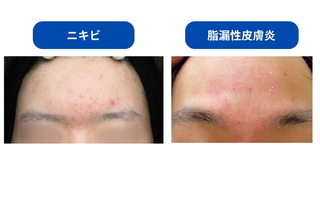 脂漏性皮膚炎