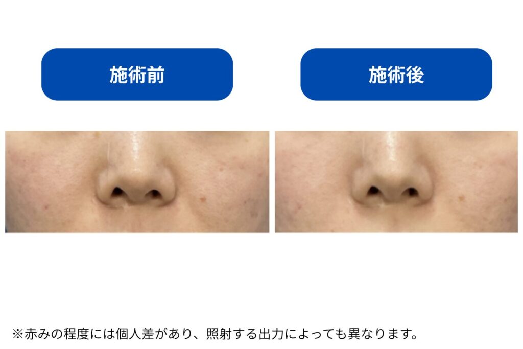 痛み・ダウンタイムの違い