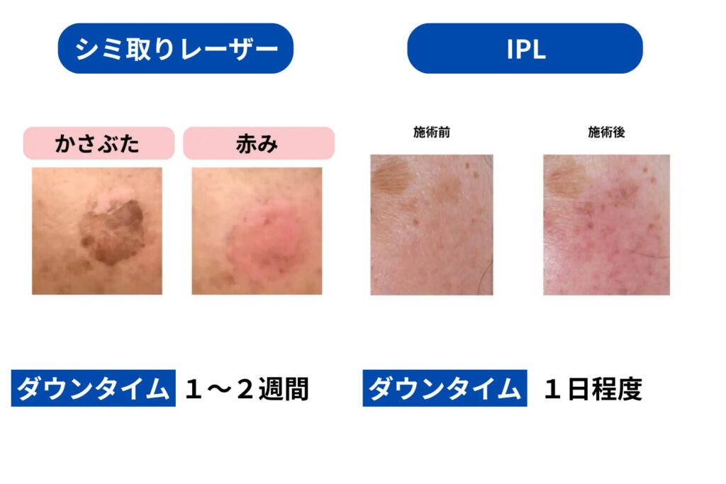 痛みとダウンタイムの違い