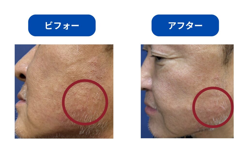 施術後に赤みや腫れが出る場合がある