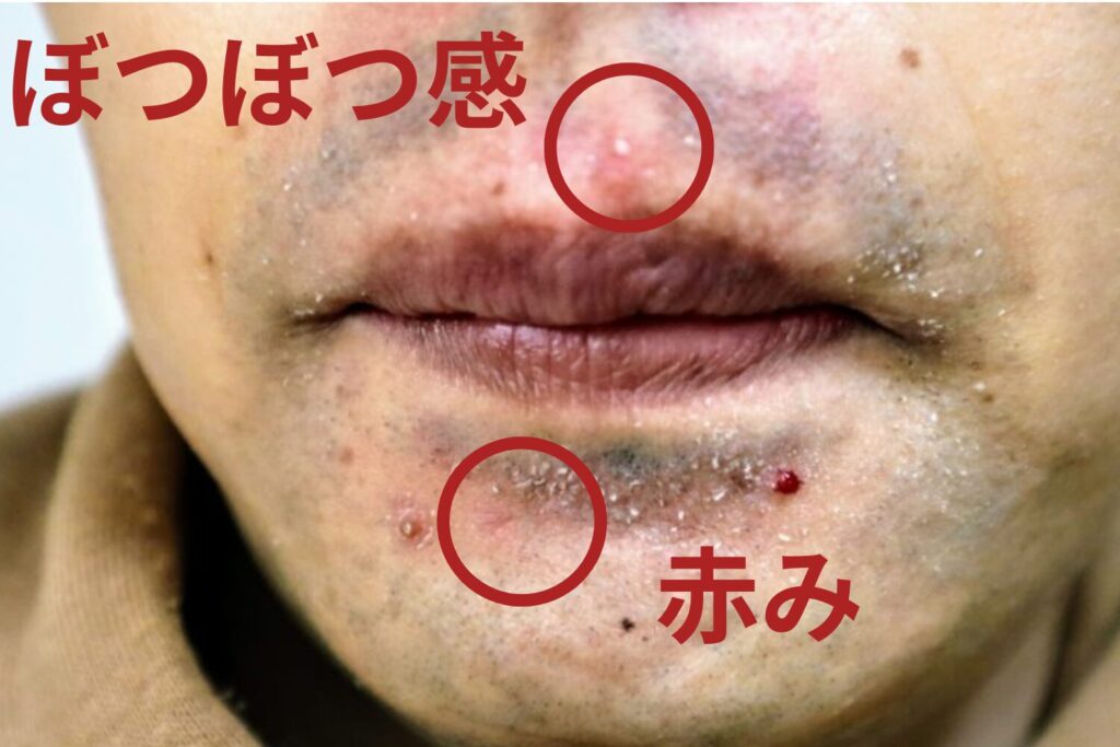 赤みやかゆみなどの主な症状