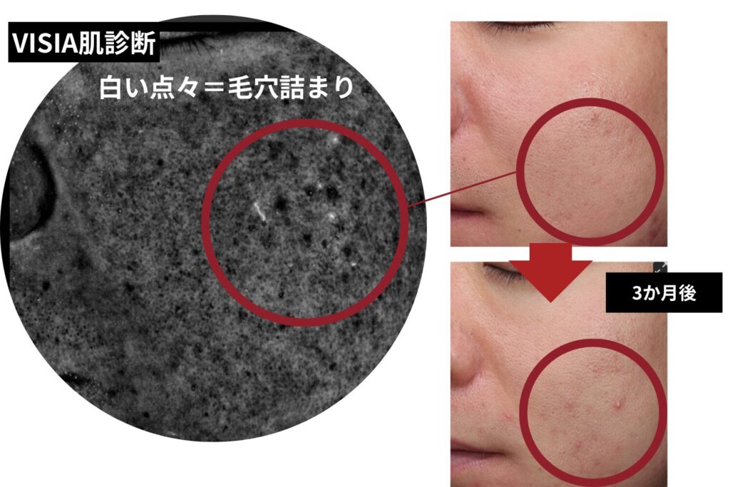 隠れニキビを放置するとどうなる?