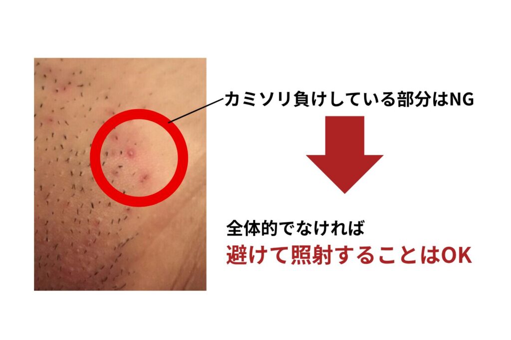 カミソリ負けしていても脱毛できる?
