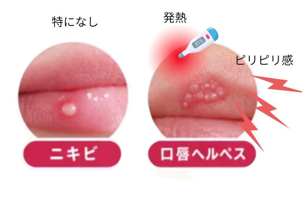 自覚症状の違い（ピリピリ感・発熱の有無）