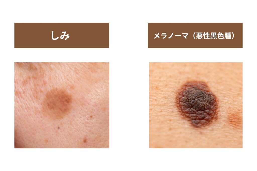 「シミだと思っていたら皮膚がんだった」事例が知られている