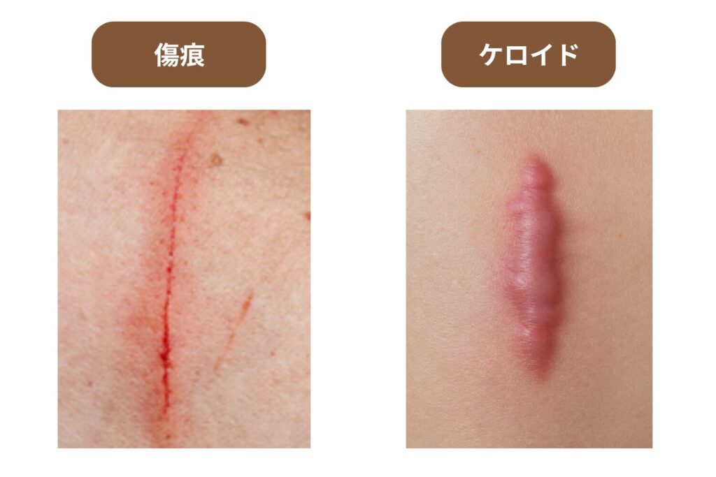 通常の傷跡との違い