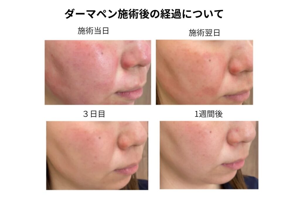 針で穴を開けるため痛みとダウンタイムがゼロにはならない