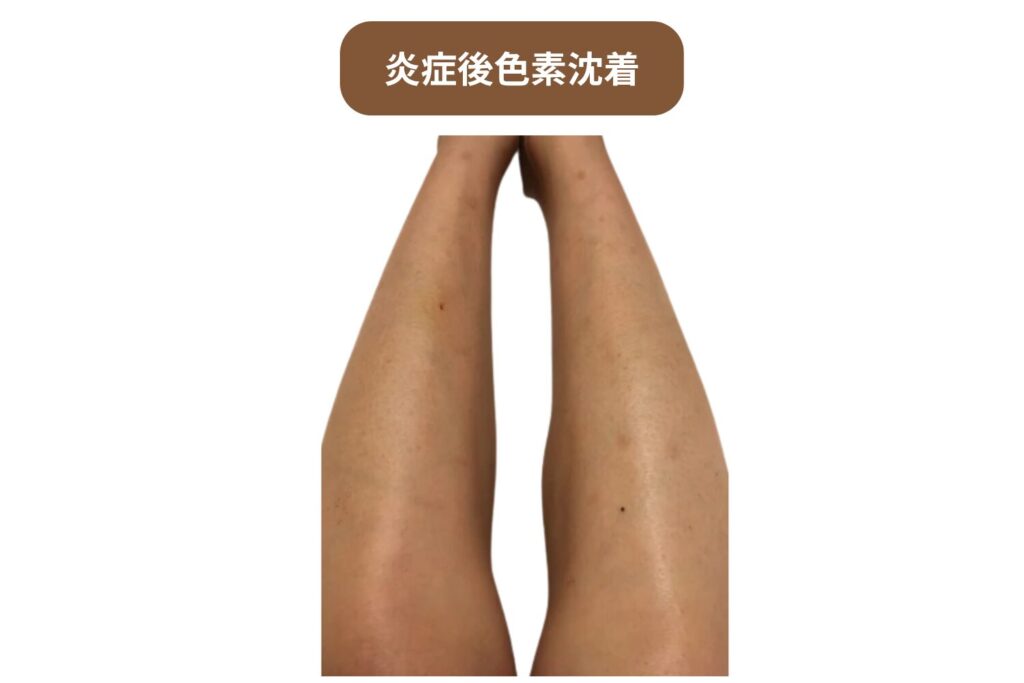 炎症後色素沈着